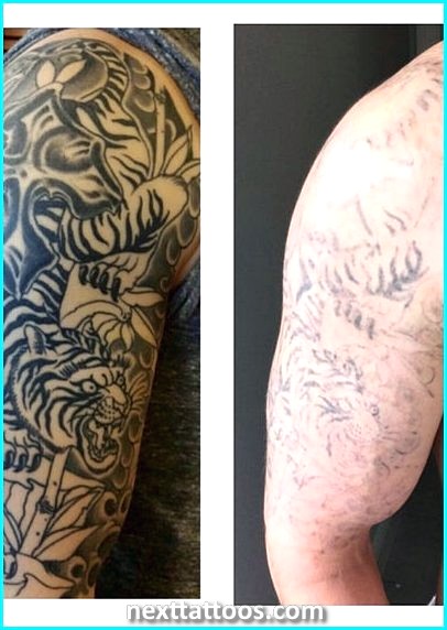 Laser Tattoo Removal Trends - Is Tattoo Removal Getting Better?